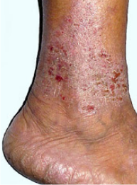 Obat Manjur Obat Eksim Pada Kulit Kaki Dan Sela Kaki obat manjur obat eksim pada kulit kaki dan sela kaki