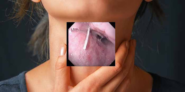 Cara Mudah Hilangkan Tulang Ikan Yang Tersangkut di Tenggorokan Saat Makan Cara Mudah Hilangkan Tulang Ikan Yang Tersangkut di Tenggorokan Saat Makan