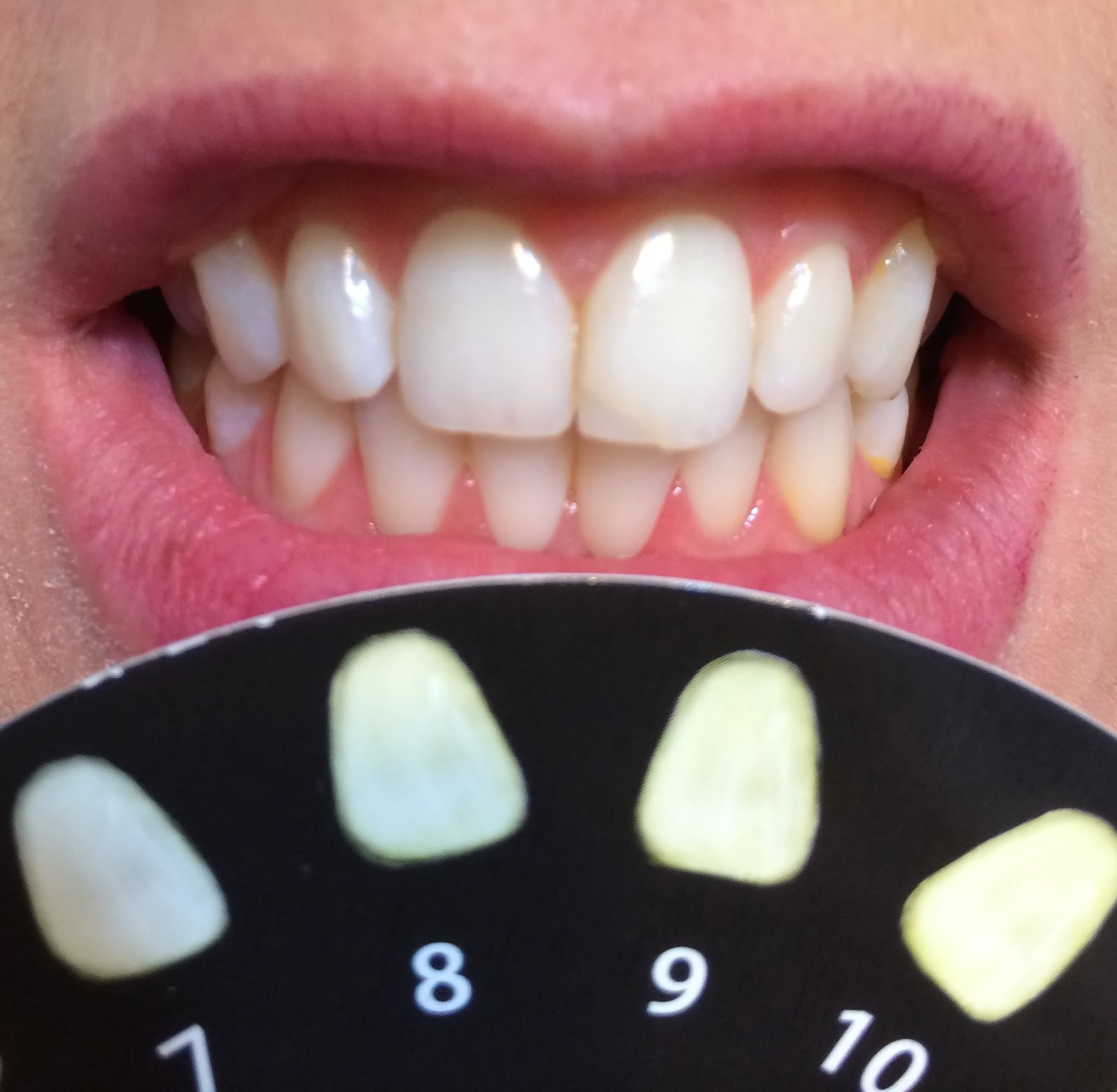 Elly hay How to whiten teeth with q tip