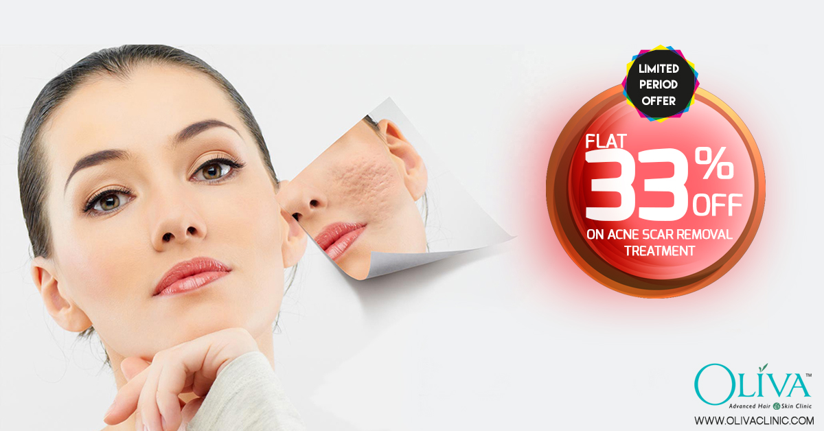 Flat 33 off on Acne Scar Treatment in Hyderabad and Bangalore Acne