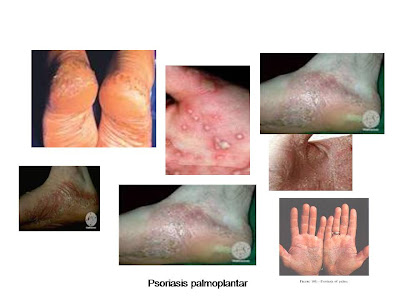 Psoriasis palmoplantar