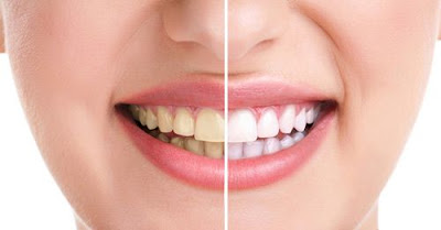 Cần lưu ý gì khi tẩy trắng răng?