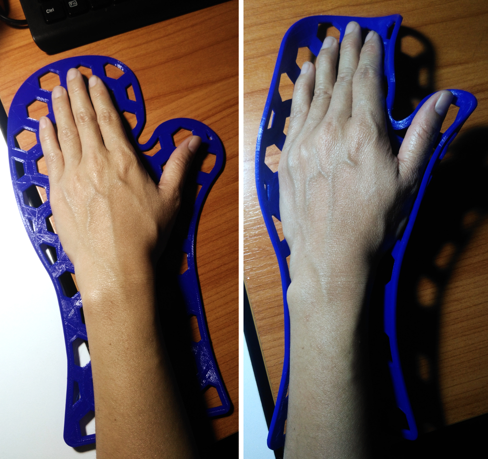 progressth 3d printing resting hand splint could save hospital 3d printer templates