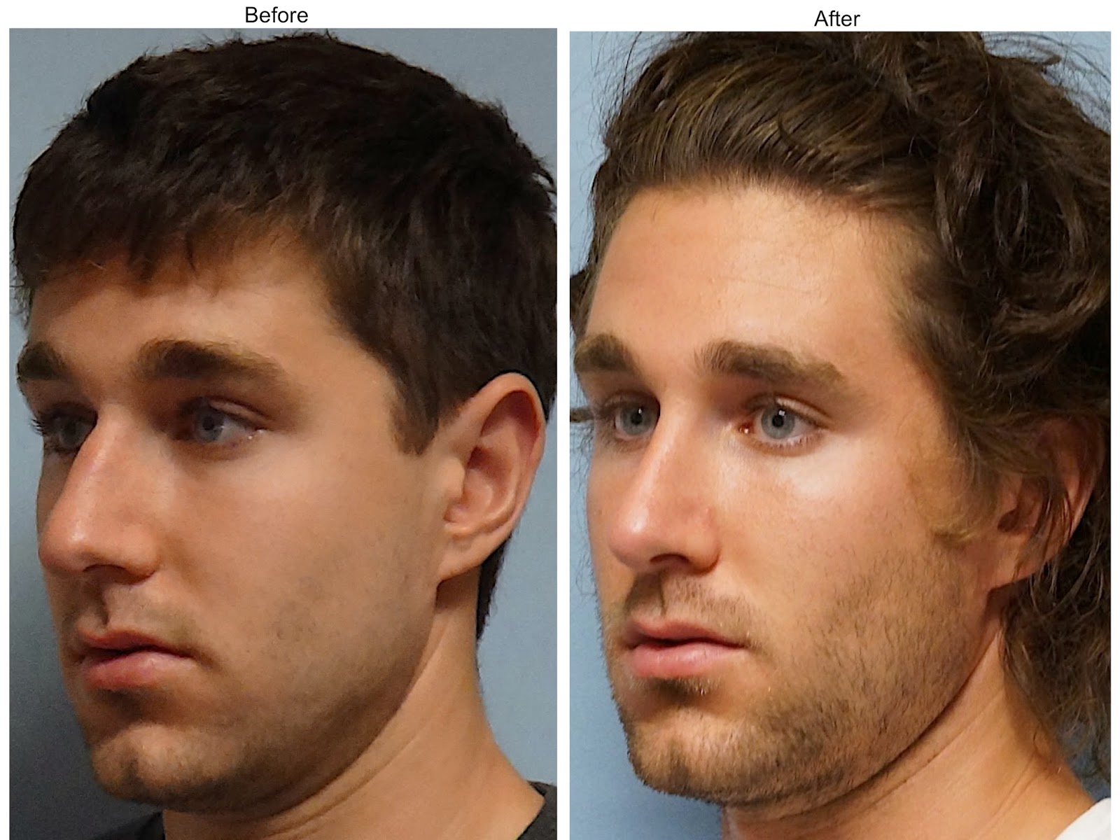 Изменился в лице когда понял. Нос мужской. Мужской подбородок. Операция на нос до и после мужчины.