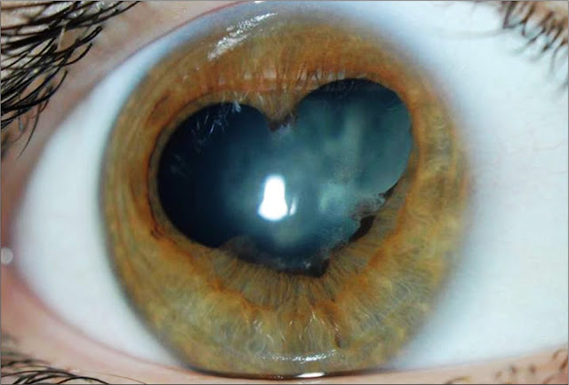 phacoemulsification