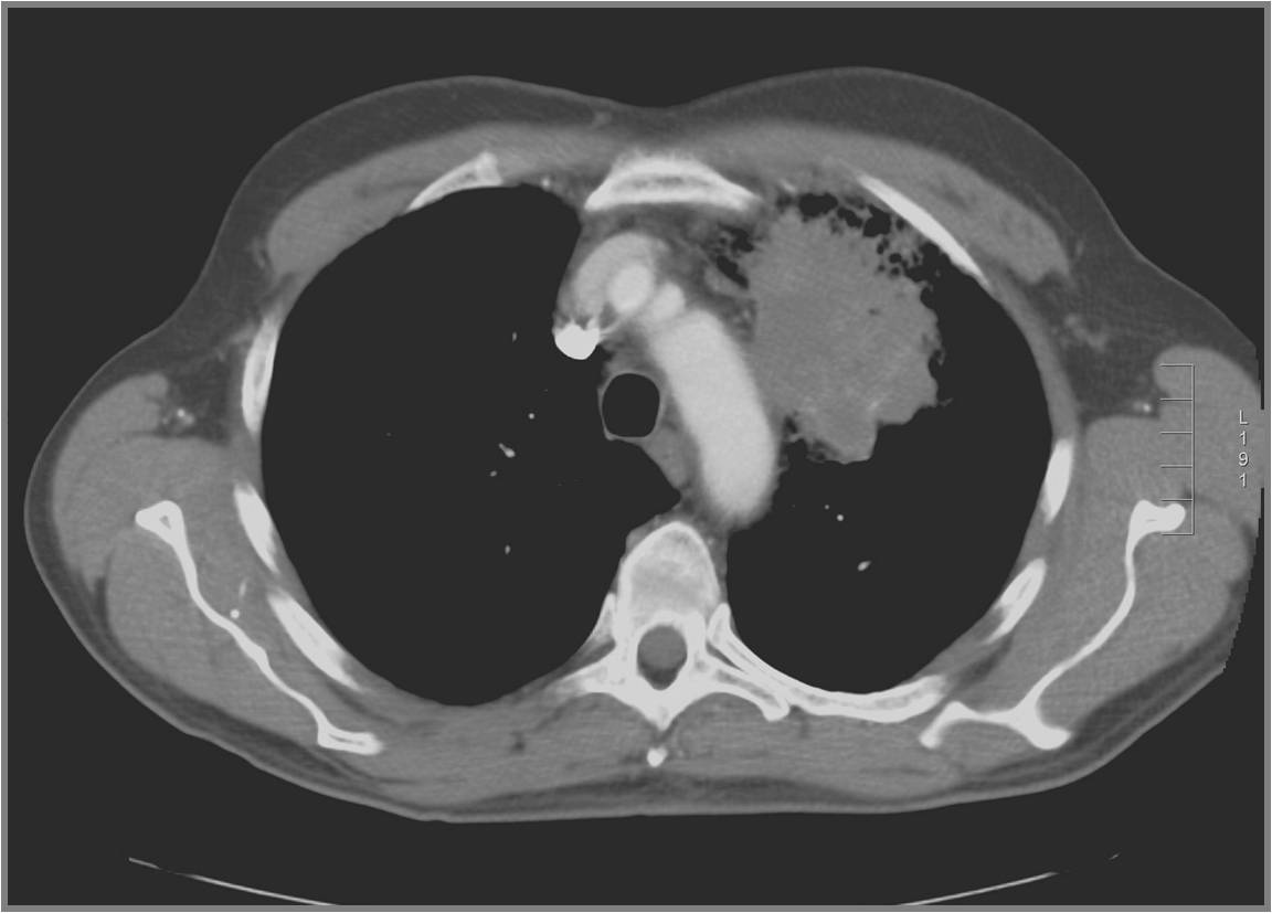 Кт легких Портал радиологов