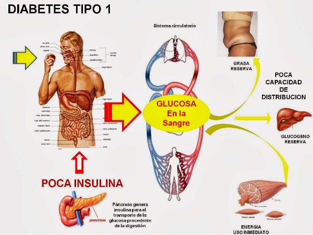 en la diabetes tipo 1 el cuerpo no produce insulina