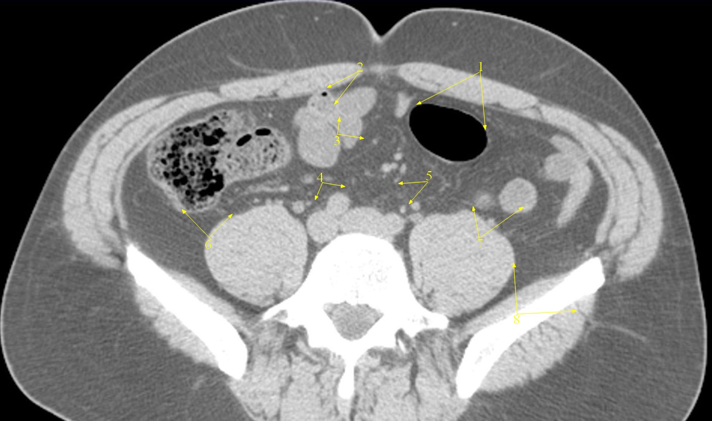 Операции по удалению грыж в МЦ Нордин