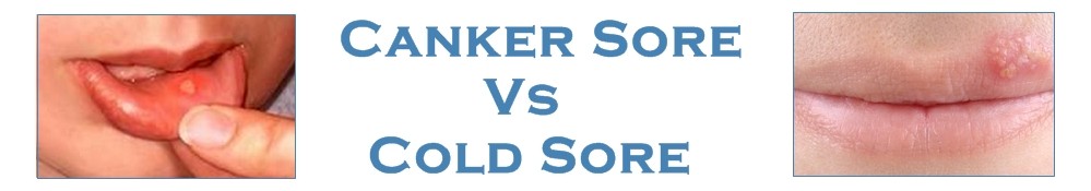 Pickering Smiles: The difference between canker sores and ...
