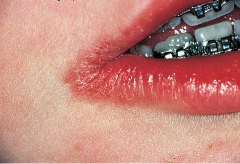 lesions on lips #11