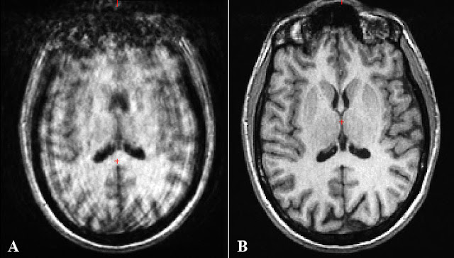 Different modality, same problem; Axial FLAIR images of the brain obtained before (A) and after (B) application of a real-time motion-correction algorithm. (MGH)