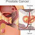 Natural Remedies for Prostate Cancer