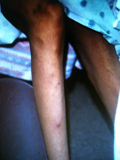 Medical Short Notes: Congenital syphilis