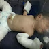 Impossible: Meet the Baby boy Who Was Born 'Pregnant' With His Own Twin Brother (Graphic Photos)