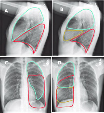 Lung cancer fingernails - Awesome Nail