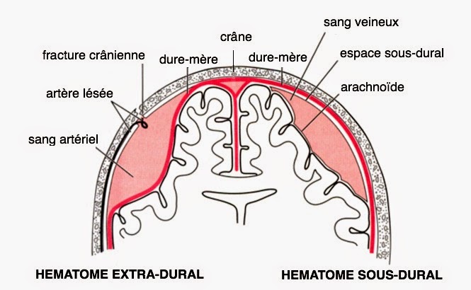 hematome sous dural