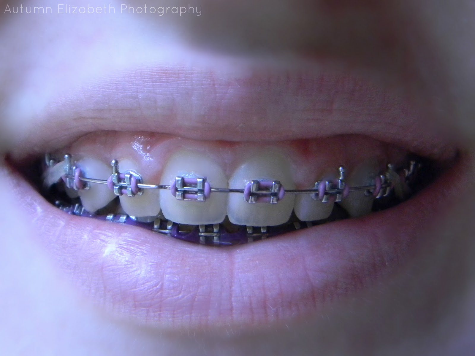 Ideas 40 of Light Blue And Light Purple Braces polepositionricotetoday