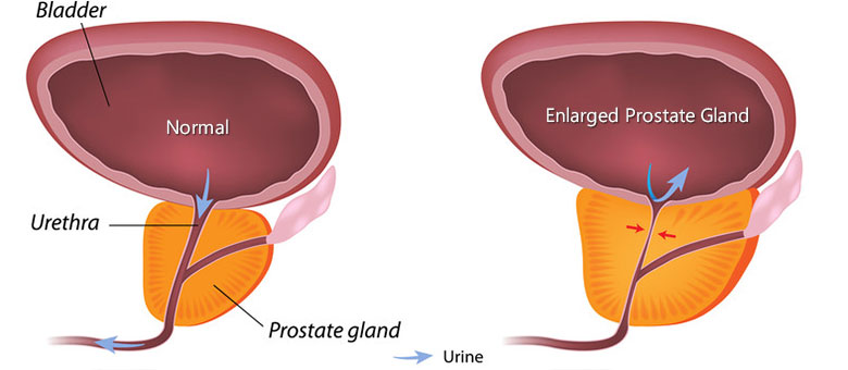 can enlarged prostate be cured