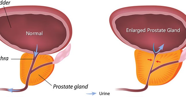 loss of median sulcus prostate a prosztatitis nyomástól