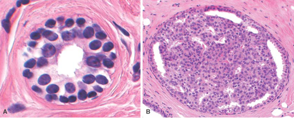 Pity, that hyperplasia in breast tissue that Can hyperplasia in breast tissue opinion you