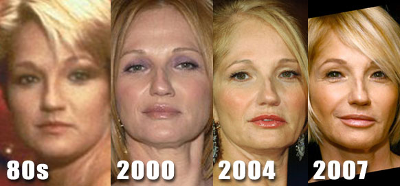 Ellen Barkin Plastic Surgery.