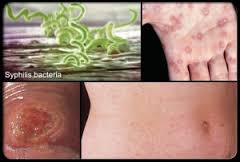 Apa Nama Obat Herbal Untuk Penyakit Sipilis