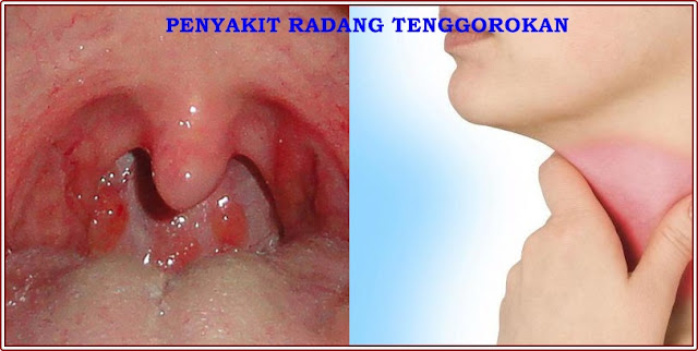 Perbedaan Radang Amandel dan Radang Tenggorokan Perbedaan Radang Amandel dan Radang Tenggorokan
