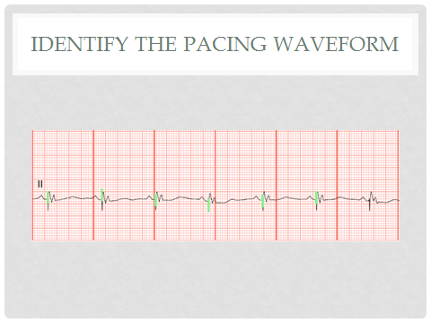 pacemaker av sequential pacemaker av sequential