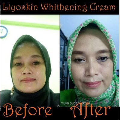 Cream Wajah Untuk Mengatasi Hiperpigmentasi Liyoskin Cream Wajah Untuk Mengatasi Hiperpigmentasi