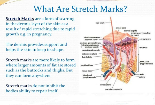 Are stretch marks hereditary?