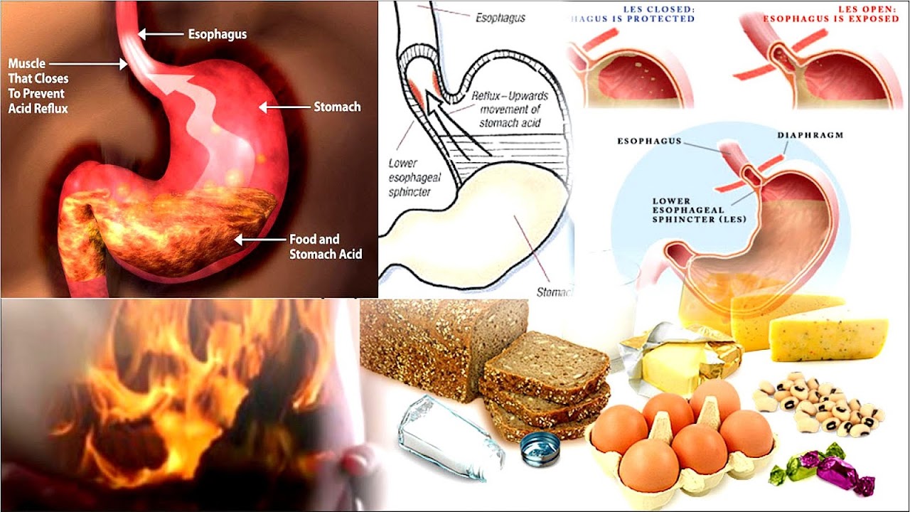 What Are The Symptoms Of Indigestion And Heartburn Hear Choices
