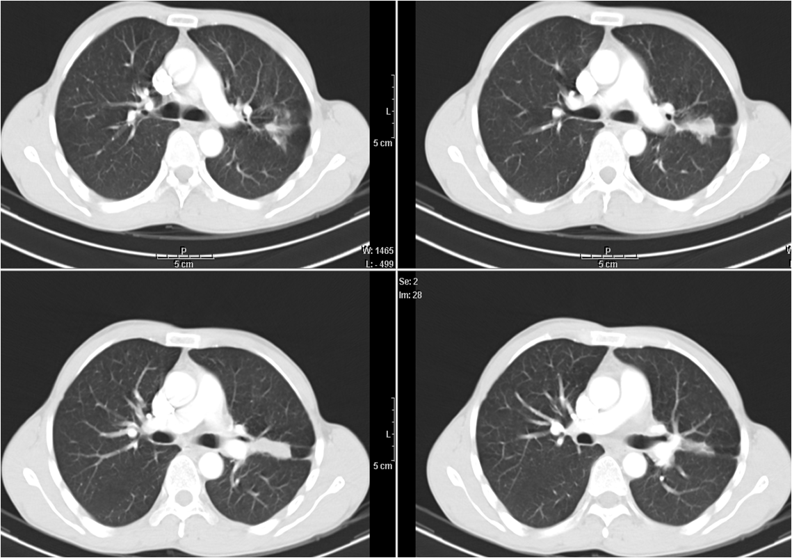 RADIOLOGY IMAGE SPOTTERS: Bronchocoele