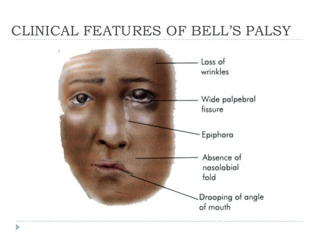 facial-nerve-paralysis