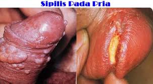 Obat Sipilis
