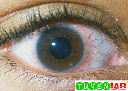 emergency atlas of corneal ulcer free medical atlas corneal ulcer