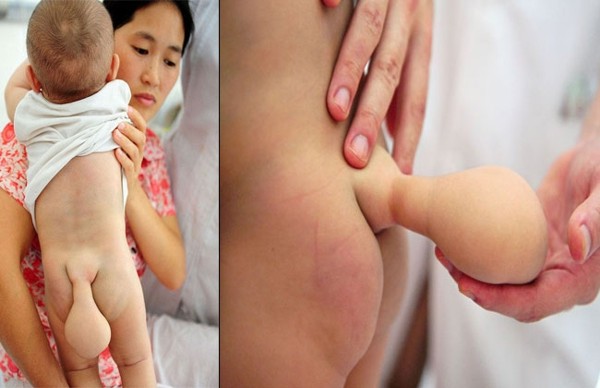 Conmoción por bebé chino con rabo de castor