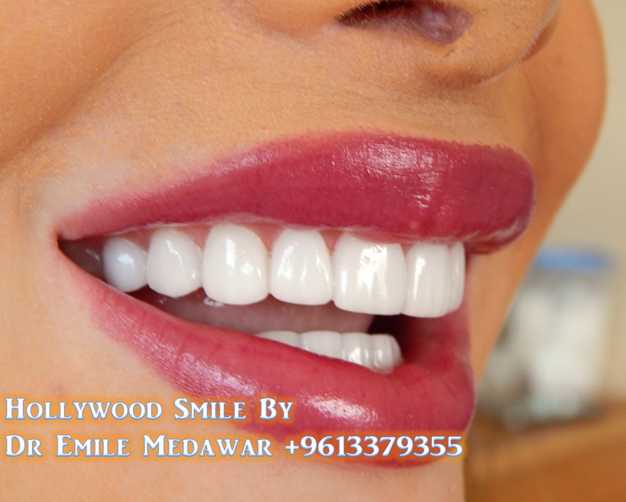 Veneers Lebanon, Best Quality, Best Price, Porcelain Veneers, Direct