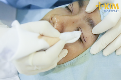 Bạn có thể loại bỏ lo ngại bấm mí mắt có nguy hiểm không khi thực hiện tại KIM Hospital