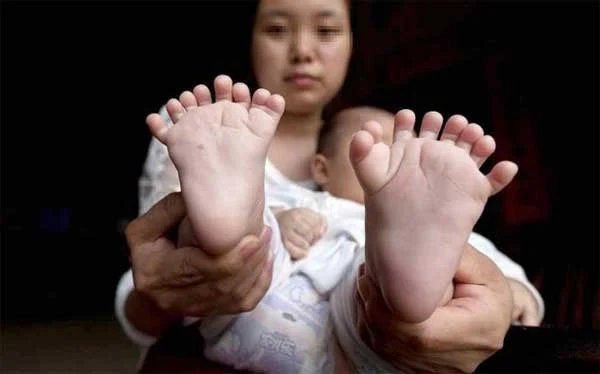 Parents seek help for baby born with 31 fingers and toes, Beijing, hospital, Treatment, Mother, Pregnant Woman, World