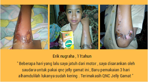 Cara Menyembuhkan Luka Borok di Kaki Secara Alami Sampai Tuntas ~ Testimoni QNC JELLY GAMAT Cara Menyembuhkan Luka Borok di Kaki Secara Alami Sampai Tuntas ~ Testimoni QNC JELLY GAMAT