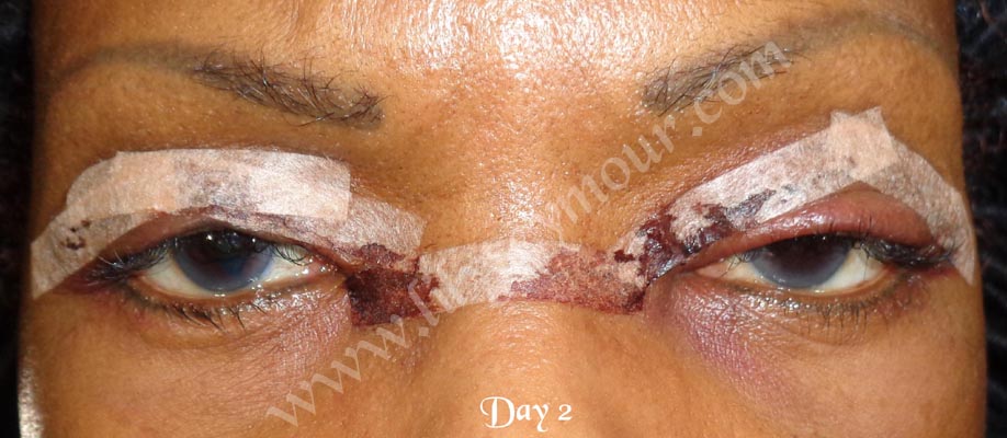 African American Ethnic Blepharoplasty Eyelid Surgery 