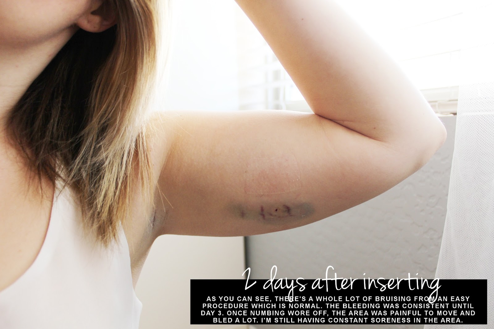 My New Implant Birth Control / AUBREY KINCH