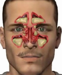 que es la sinusitis cronica y como se cura que es la sinusitis cronica y como se cura