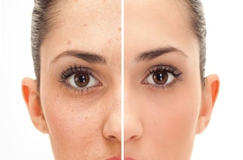 Image result for perawatan karena bintik hitam