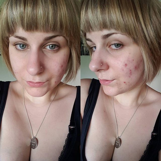 Skin Deep 2 A New Regime And Acne Update Emlwy