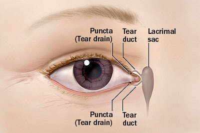 Tear duct obstruction in adults