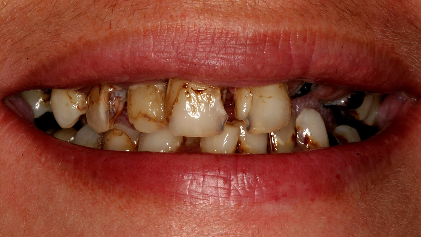 The Effects Of Soda On Teeth Effect Choices