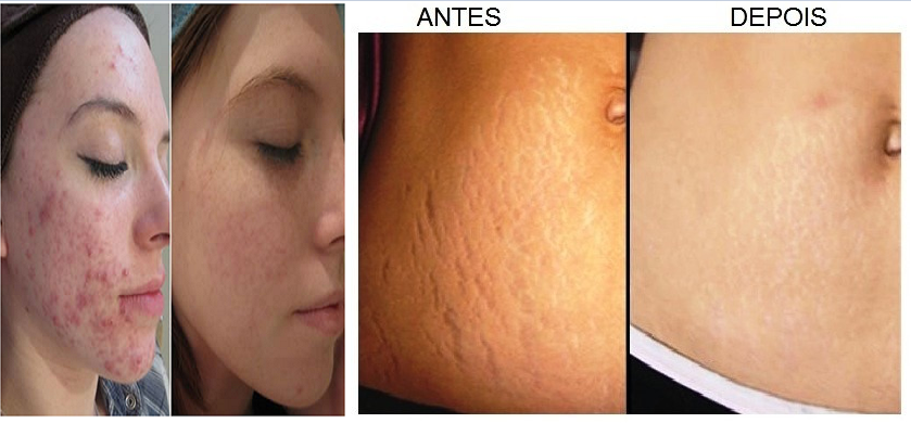 2.bp.blogspot.com/-EzEuoGx9GfA/WHEit8gVK7I/AAAAAAAABOw/bPeqswjnC9scDhEn2i6zuPytk_A-sUOGwCLcB/s1600/Dermaroller%2BDerma%2BRoller%2BSystem%2B0.5mm%2Be%2B1.0%2Bmm%2B540%2BAgulhas%2B%25284%2529.PNG