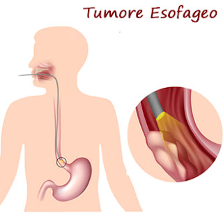 Neoplasie dell'esofago e lesioni