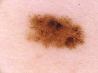 Medidas preventivas que hay que adoptar para evitar el cancer de piel 